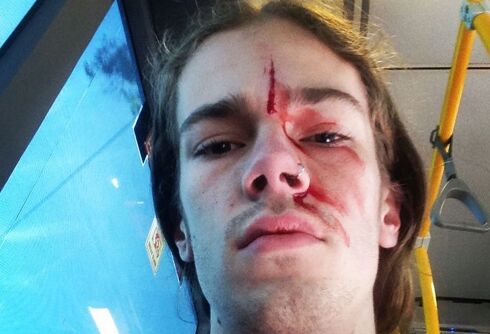 This teen was attacked when he confronted a homophobe in the street