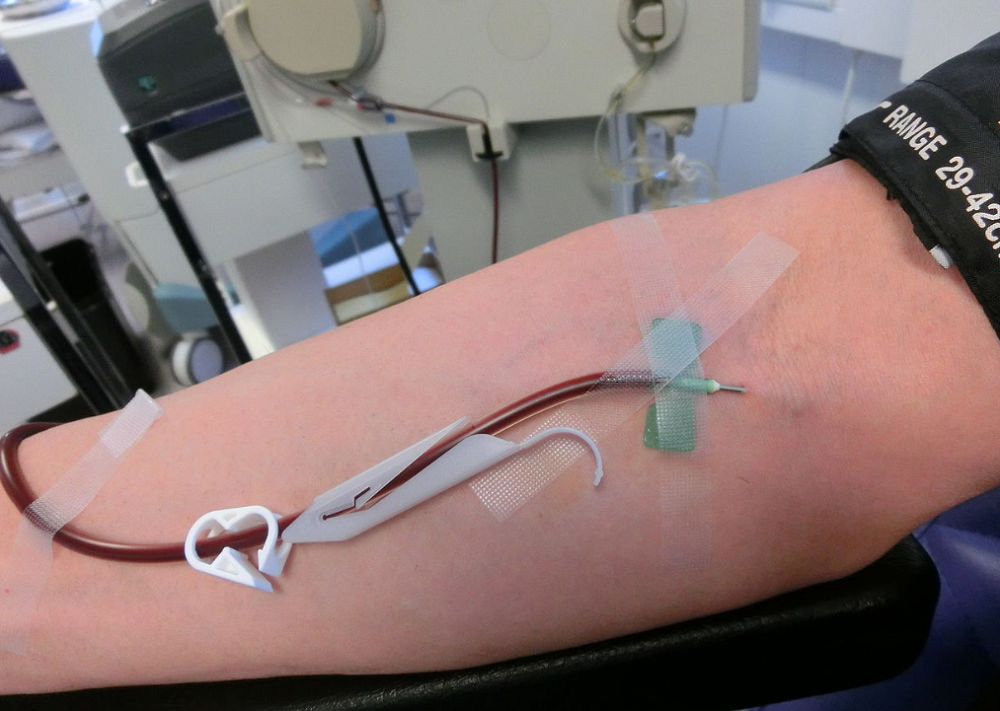 An arm with needles and tubes in it. It's a person donating blood plasma