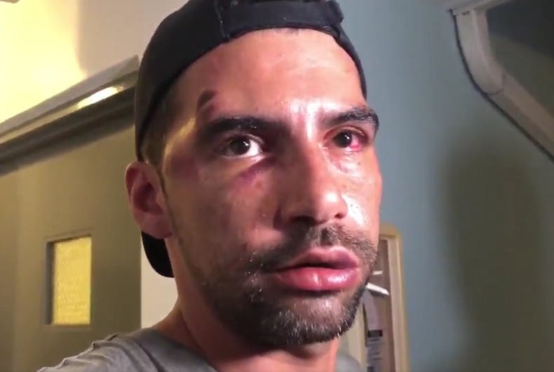 Rene Chalarca with facial injuries after the attack