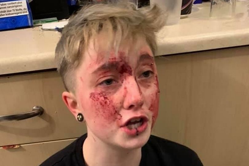 Lesbian left covered in her own blood after two men brutally beat her