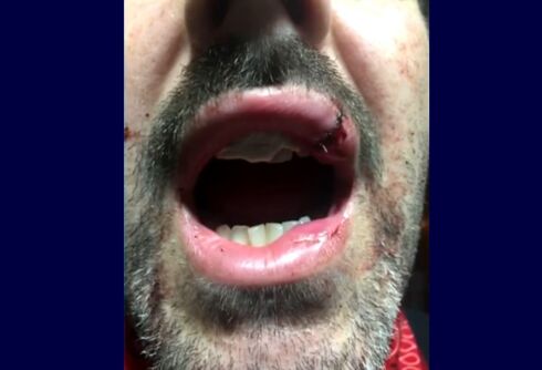 Gay man loses two front teeth in horrifying attack after putting up a rainbow flag