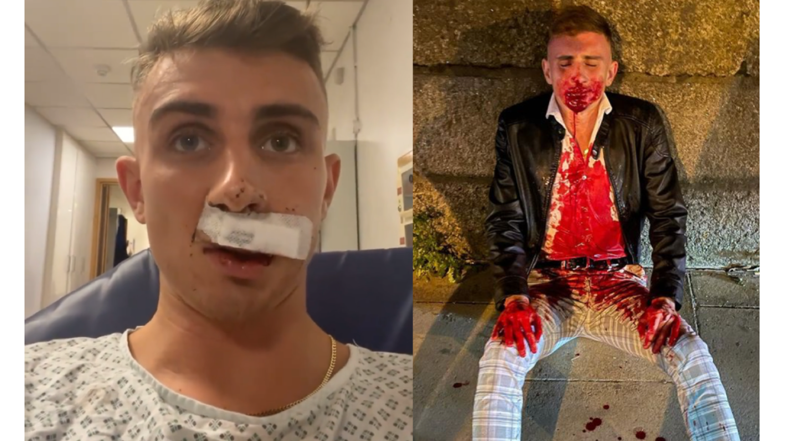 Jack Woolley was punched by "mistake" in the streets of Dublin. His lip will require surgery to be repaired.