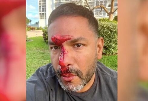 Man walking his dog left with fractured face when stranger punches him after asking if he’s gay