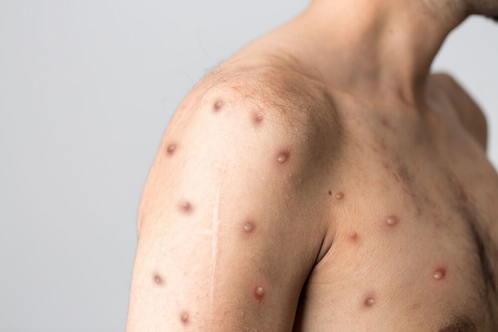 A person with mpox