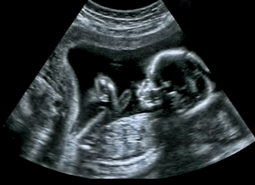 A fetus in an ultrasound