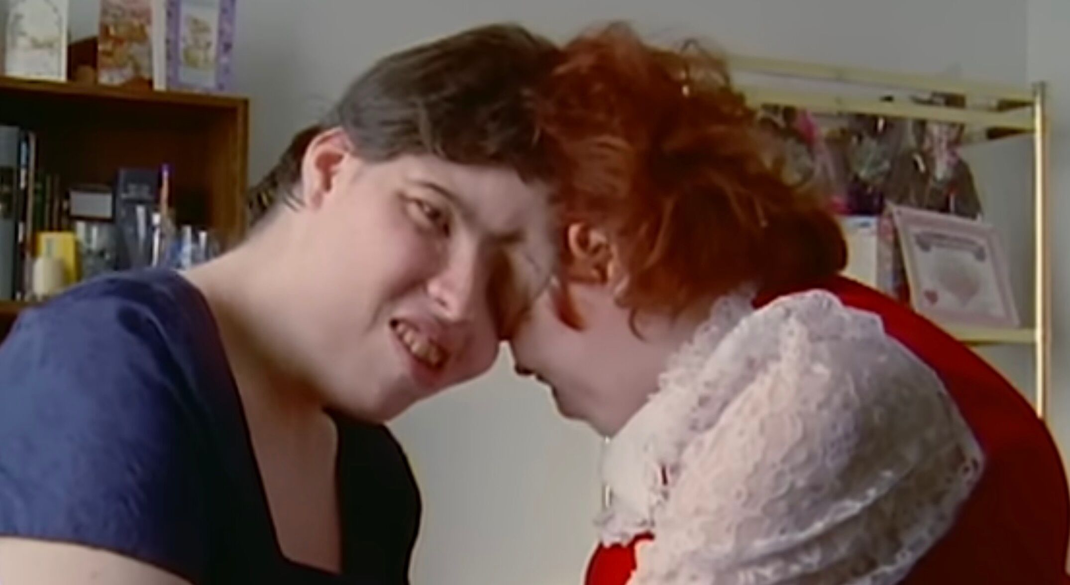 The first set of conjoined twins to identify as different genders has died at 62