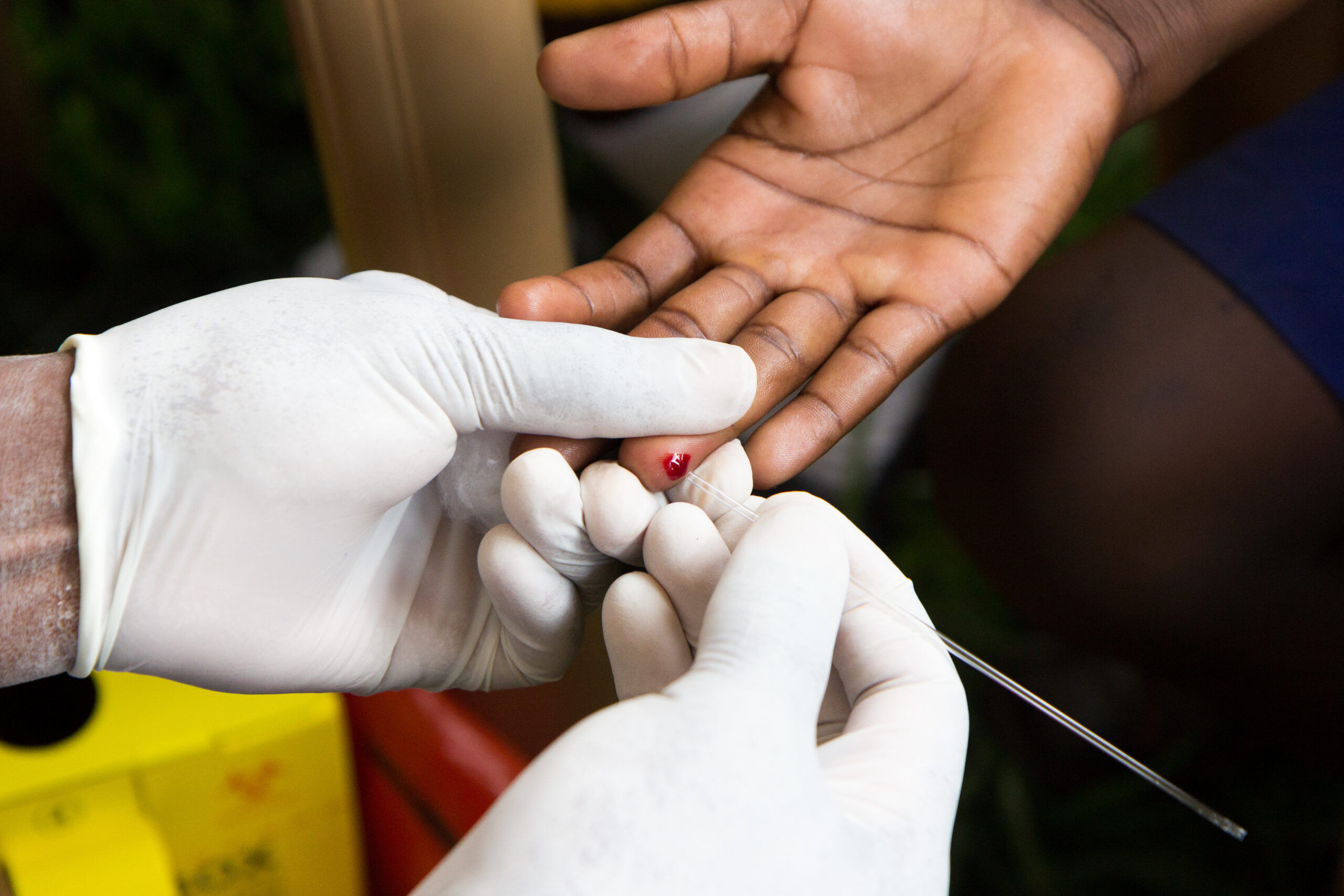 A health care worker doing a finger prick test for HIV in Uganda in 2017,