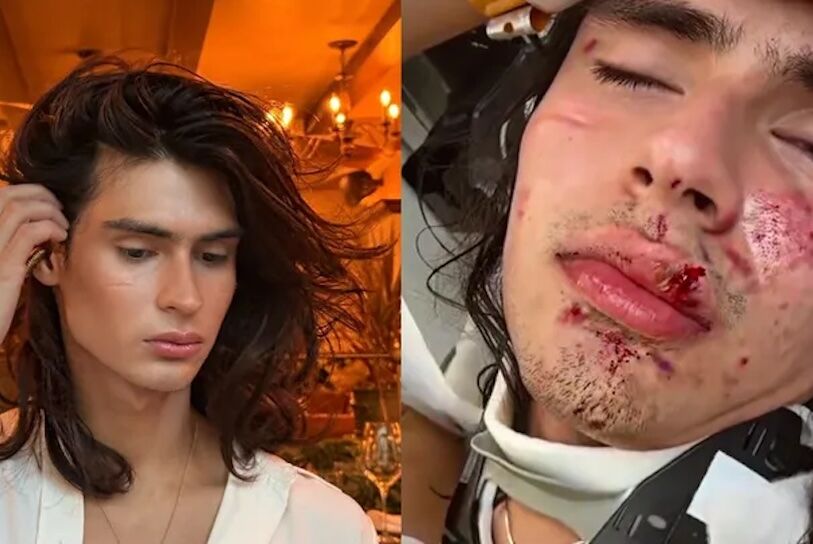 Sebastian Thomas Robles Lascarro before and after the attack